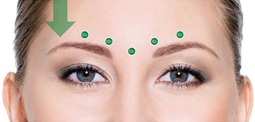 botox aplicacion frente esquema